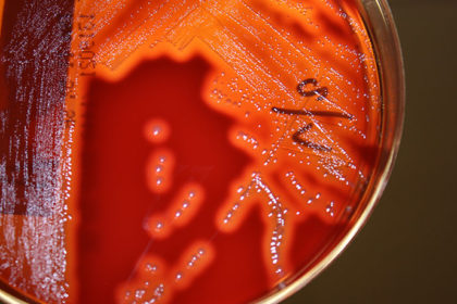 psoriasi guttata - streptococcus pyogenes