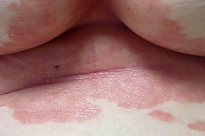 psoriasi inversa