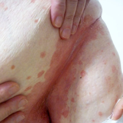 psoriasi inversa