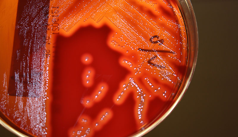 psoriasi guttata - streptococcus pyogenes